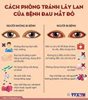 Xã Phú An hướng dẫn nhân dân cách phòng, chống bệnh đau mắt đỏ